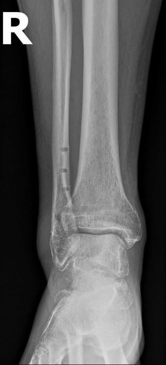 2019-05-20  (15 wks post surgery) ankle xray0.jpg